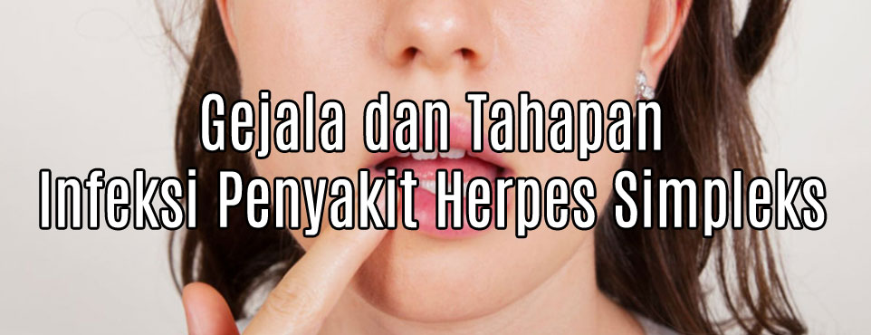 Gejala dan Tahapan Infeksi Penyakit Herpes Simpleks