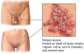 gambar penyakit herpes simplex