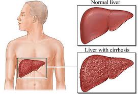 Informasi Lengkap Penyakit Liver